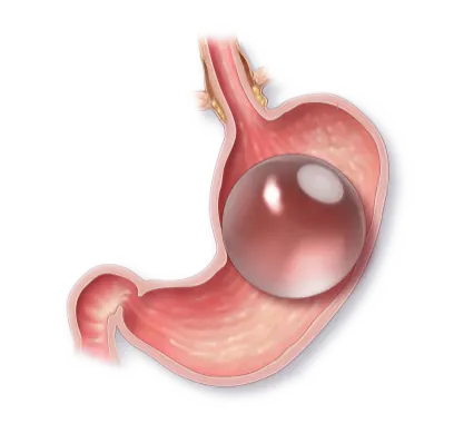 Intragastric Balloon Distributor and Private Hospital Sourcing Guide